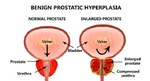 Is Nitinol Device an Effective Treatment for Benign Prostatic Hyperplasia Patients?