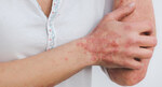 Trial finds Deucravacitinib is Effective For Moderate to Severe Plaque Psoriasis