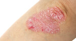 Investigational Drugs bring hope to those suffering from Psoriasis