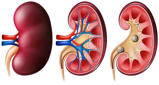 Clinical trial confirms SGLT2 provides kidney protection in diabetic patients