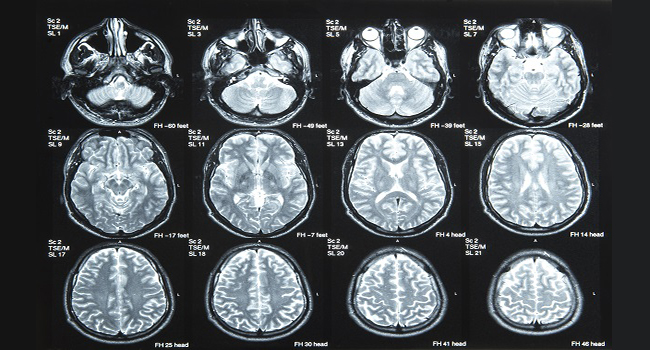 Clinical trial reveals benefits to dissolving stroke blood clots before surgical removal