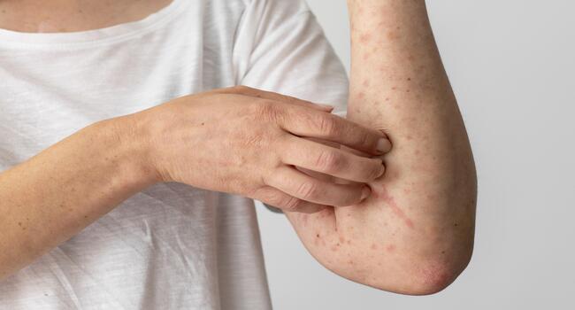 Two drugs combine to provide relief for atopic dermatitis