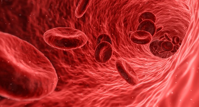 Clinical trial finds that hydroxyurea is effective in reducing stroke risk in children with sickle cell anemia
