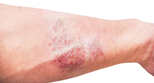 Clinical trial reveals safe effective treatment for atopic dermatitis