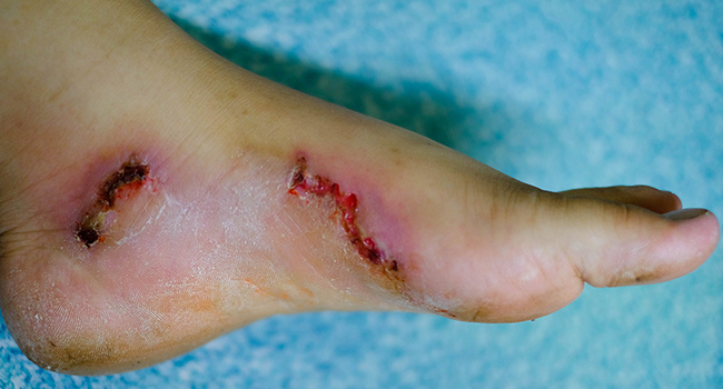 Clinical trial finds that Dermaheal ointment provides faster healing and smaller diabetic foot ulcers