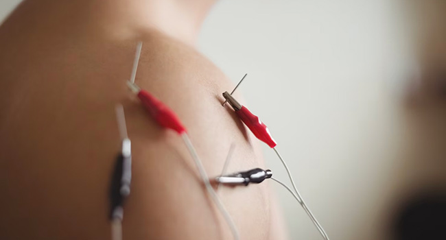 Clinical trial finds that electroacupuncture makes gastroscopy more comfortable