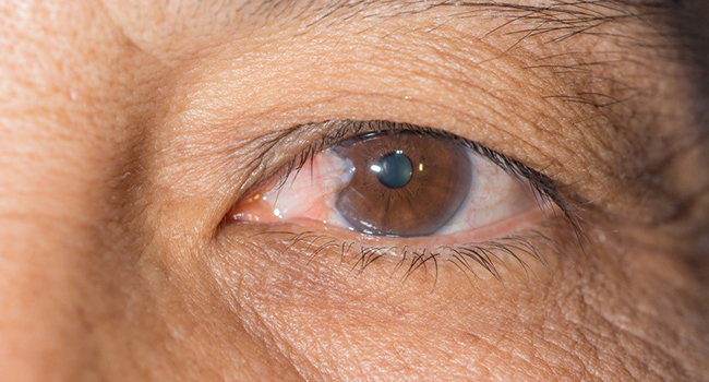 Clinical trial compares fibrin glue with sutures for pterygium eye surgery