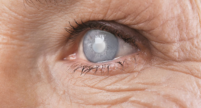 New treatment for glaucoma discovered in clinical trial