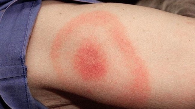 Yearly injection against Lyme disease is under development