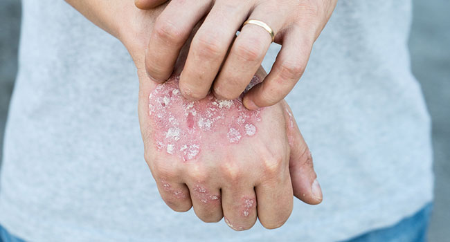Clinical trial results in help for plaque psoriasis sufferers