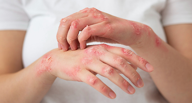 Clinical trial finds new treatment for psoriasis and atopic dermatitis
