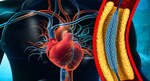 Clinical Trial evaluates a New Approach for Heart Disease Treatment