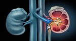 Clinical Trial Compares Two Techniques for Large Kidney Stone Removal