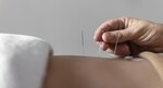 Clinical Trial Explores Acupuncture as Treatment for Anxiety in Parkinson's Patients