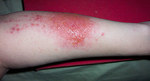 Drug shows Efficacy against Contact Dermatitis