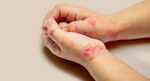 Are You Concerned About Eczema? See What Doctors Say!
