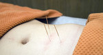 Acupuncture may Alleviate Indigestion