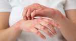 Breakthrough Treatment for Eczema and Psoriasis