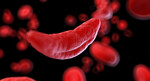 Sickle Cell Disease: a Painful Hereditary Condition