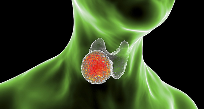 Clinical trial finds that combination therapy for anaplastic thyroid cancer does not prolong life