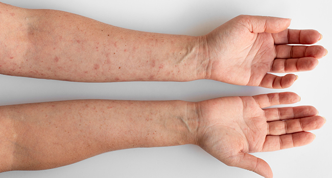 Atopic Dermatitis, Eczema clinical trials