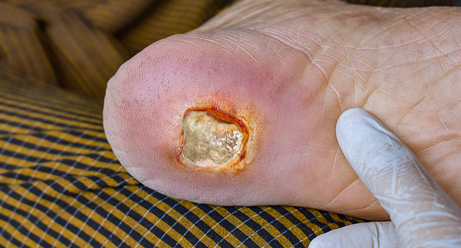 About Diabetic Foot Ulcers