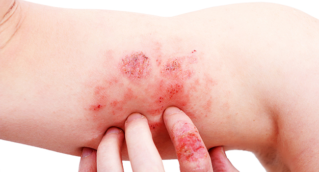 Eczema Clinical Trials