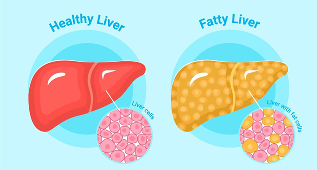 About Fatty Liver Disease